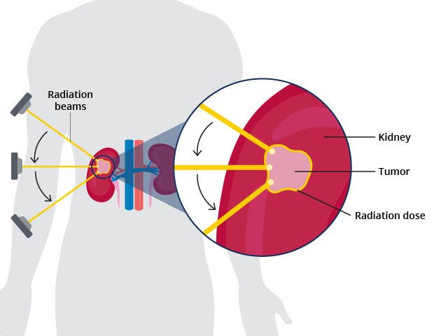 Could Radiation Before Surgery Help Patients With Difficult Kidney Cancer?